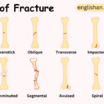 Types of bone Fracture Names in English