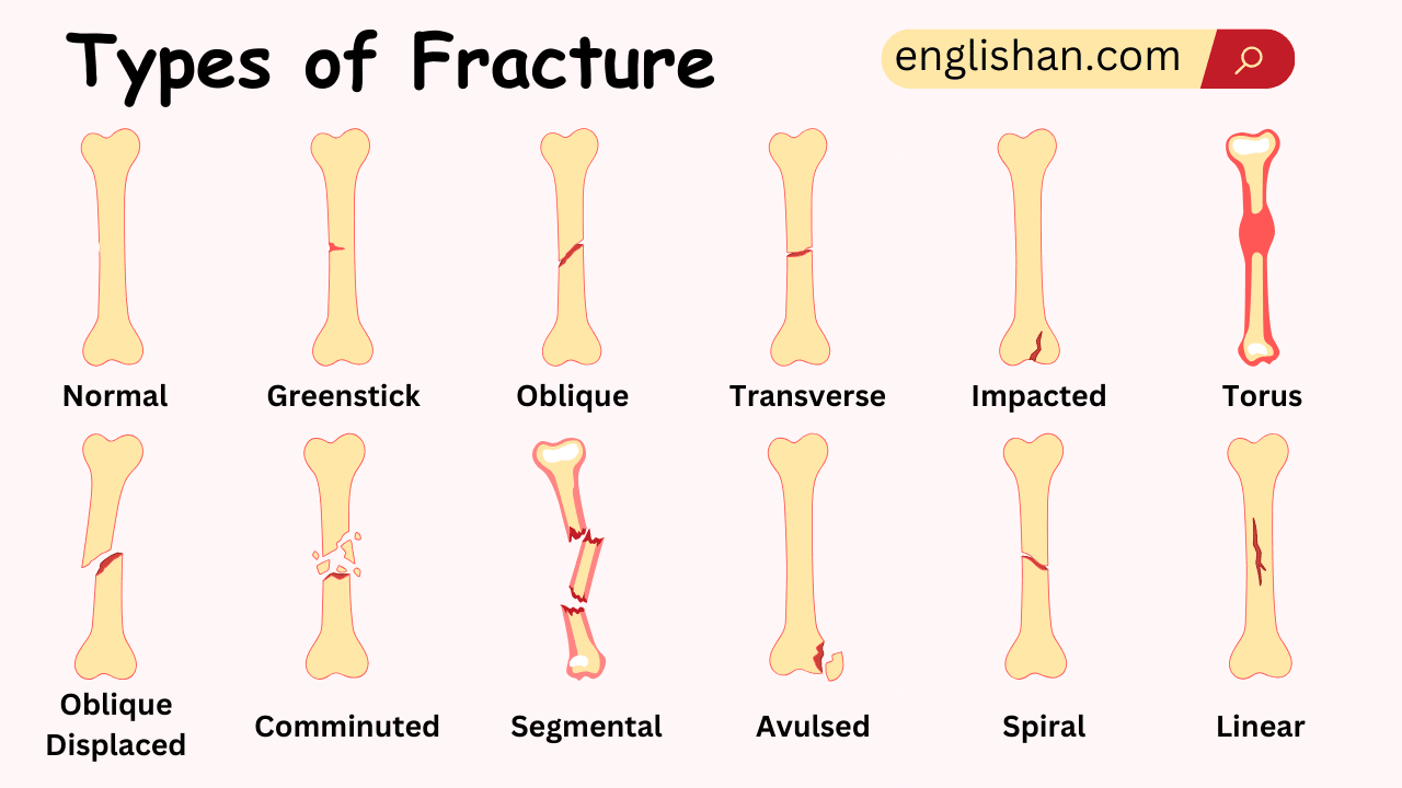 Types of bone Fracture Names in English