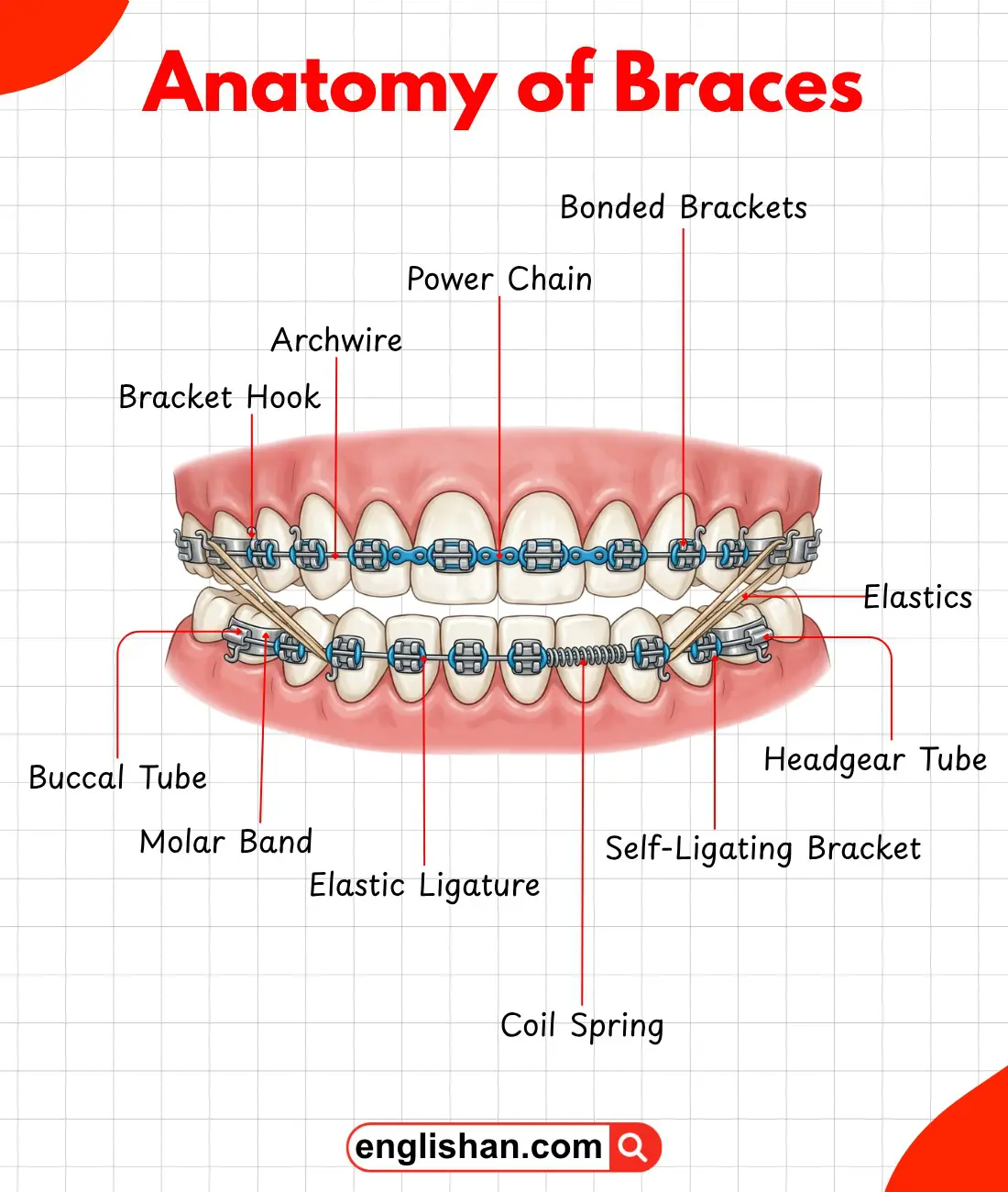 Labeled diagram showing the anatomy of a dental brace.