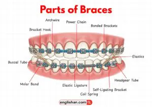 Diagram showing the main parts of orthodontic braces on teeth.