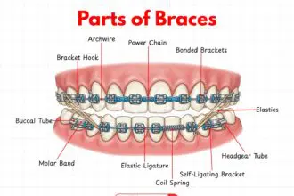 Diagram showing the main parts of orthodontic braces on teeth.