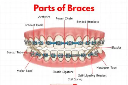 Diagram showing the main parts of orthodontic braces on teeth.