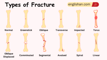 Types of Fracture Names in English